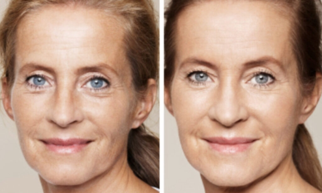 Skin Boosters