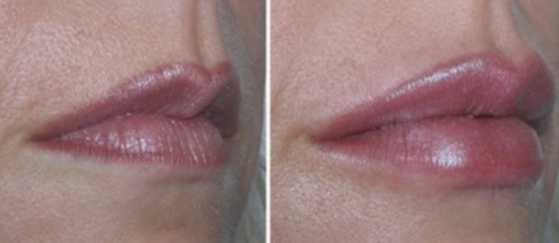 dermal filler